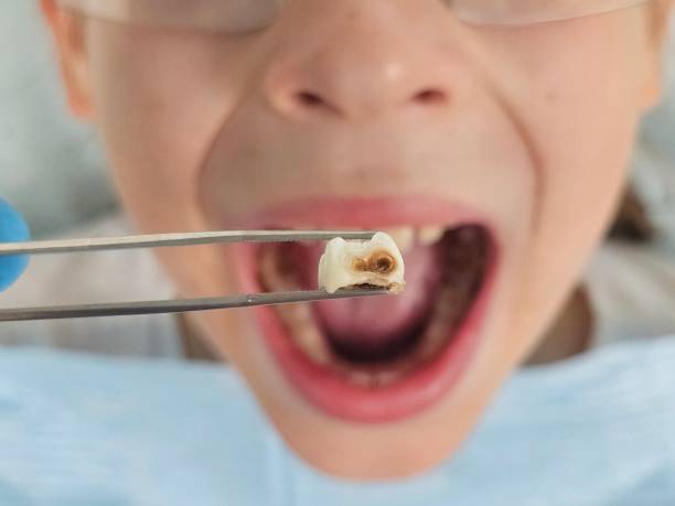 Best Emergency Tooth Extraction in Johnstonville, CA